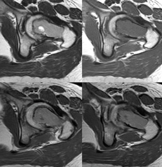 Figure 5 for case Clear cell chondrosarcoma ( RID4142 )
